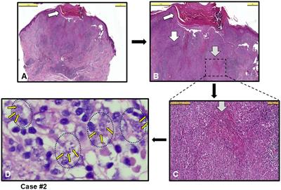 Diagnostic challenges in cutaneous leishmaniasis due to atypical Leishmania infantum: pathologists’ insights from re-emergence zones
